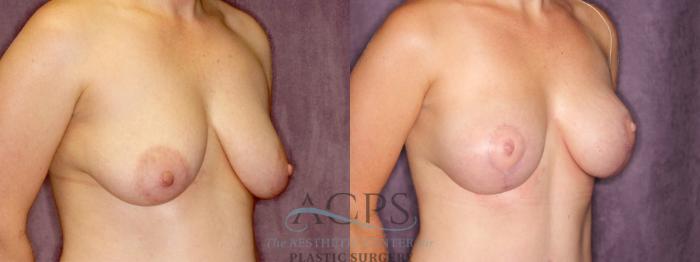 Before & After Breast Augmentation and Lift Case 1044 Oblique Right View: View in Houston, TX
