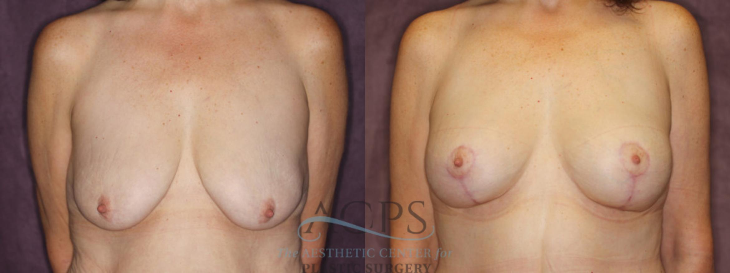 Before & After Breast Augmentation and Lift Case 1045 Front View: View in Houston, TX