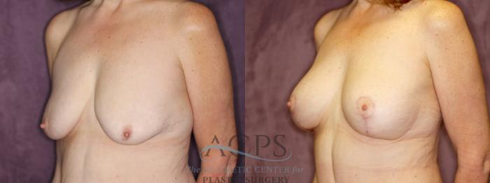 Before & After Breast Augmentation and Lift Case 1045 Oblique Left View: View in Houston, TX