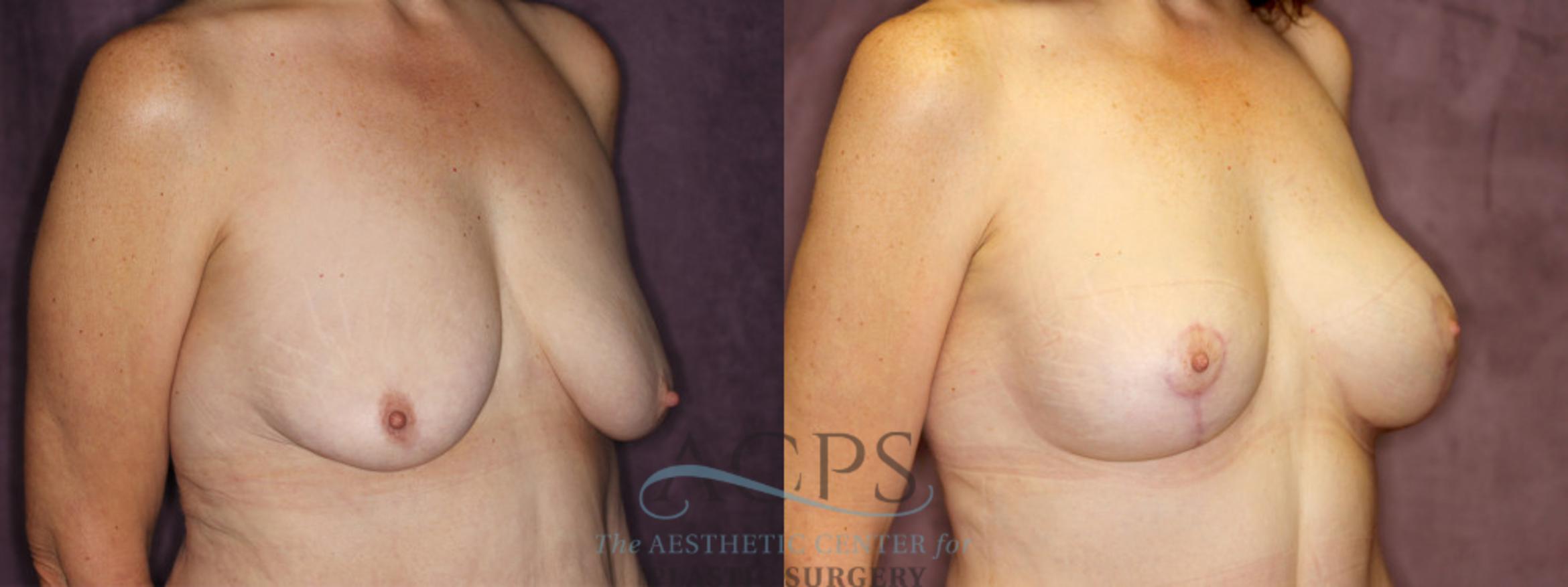 Before & After Breast Augmentation and Lift Case 1045 Oblique Right View: View in Houston, TX