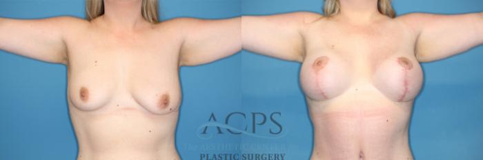 Before & After Breast Augmentation and Lift Case 1492 Front 2 View in Houston, TX