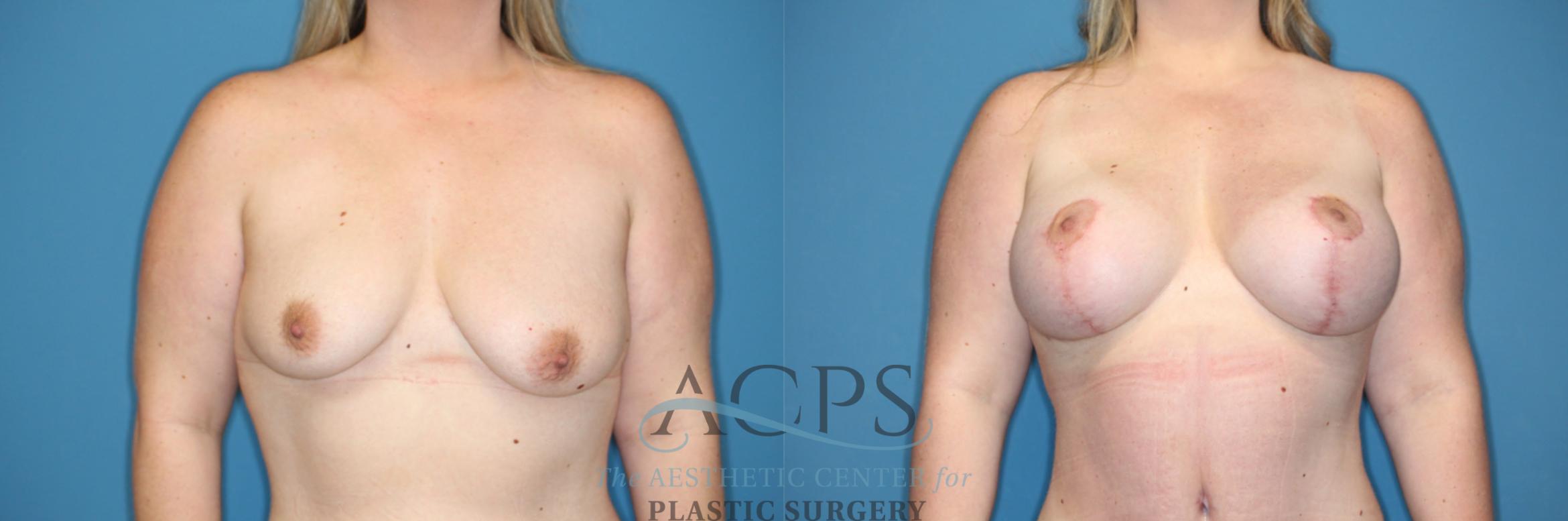 Before & After Breast Augmentation and Lift Case 1492 Front View in Houston, TX