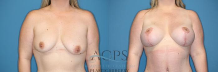 Before & After Breast Augmentation and Lift Case 1492 Front View in Houston, TX