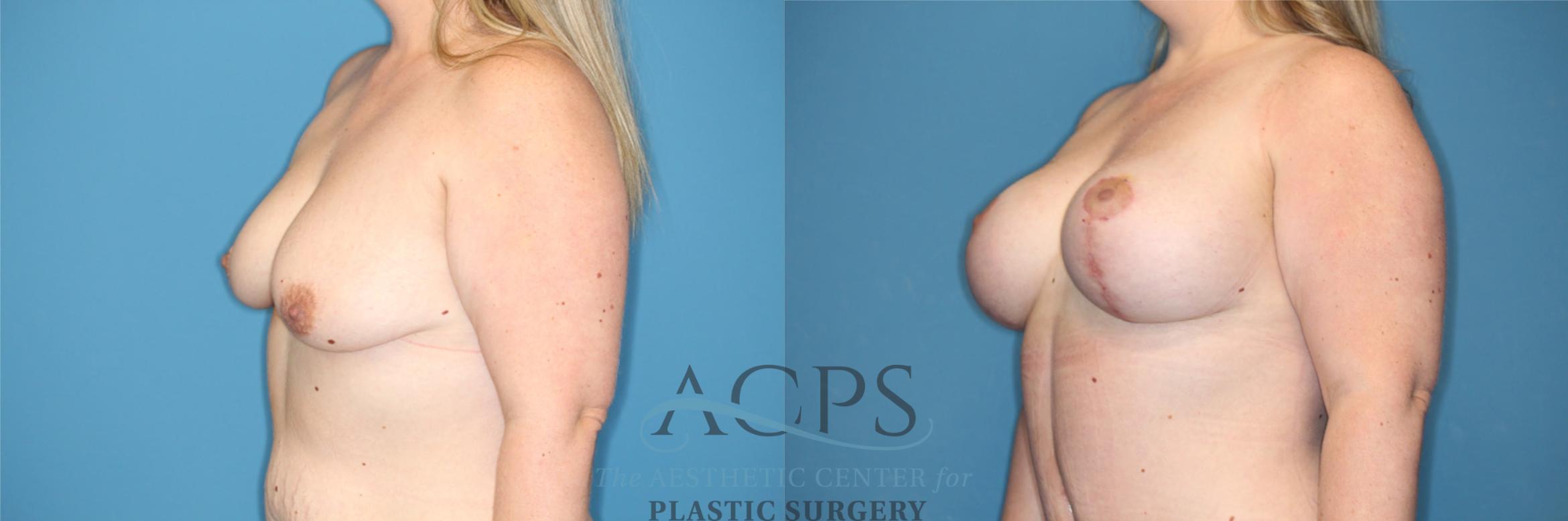 Before & After Breast Augmentation and Lift Case 1492 Left Oblique View in Houston, TX