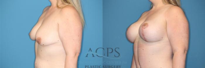 Before & After Breast Augmentation and Lift Case 1492 Left Oblique View in Houston, TX