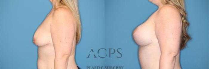 Before & After Breast Augmentation and Lift Case 1492 Left Side View in Houston, TX