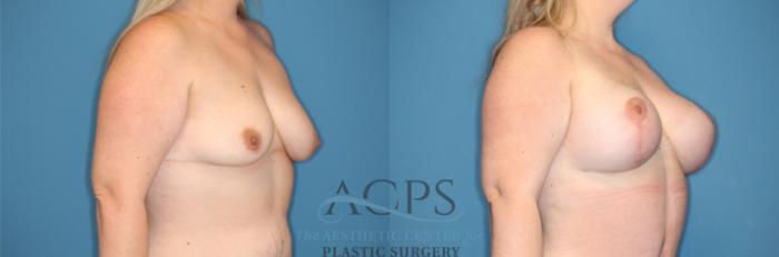 Before & After Breast Augmentation and Lift Case 1492 Right Oblique View in Houston, TX