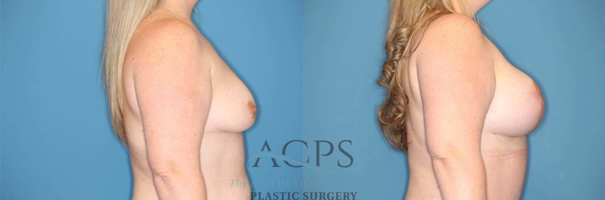 Before & After Breast Augmentation and Lift Case 1492 Right Side View in Houston, TX