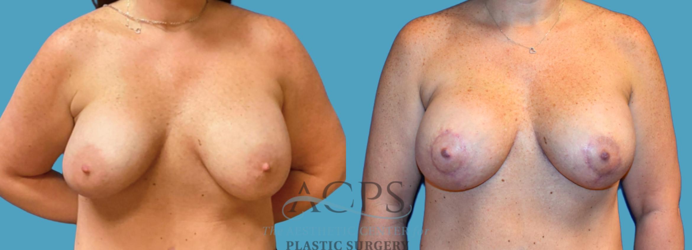Before & After Breast Augmentation and Lift Case 1523 Front View in Houston, TX