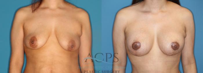 Before & After Breast Augmentation and Lift Case 1524 Front View in Houston, TX