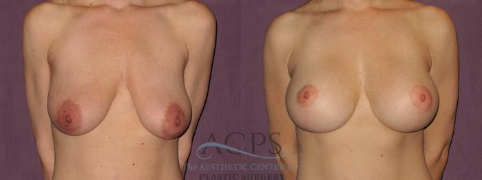 Before & After Breast Augmentation and Lift Case 1525 Front View in Houston, TX