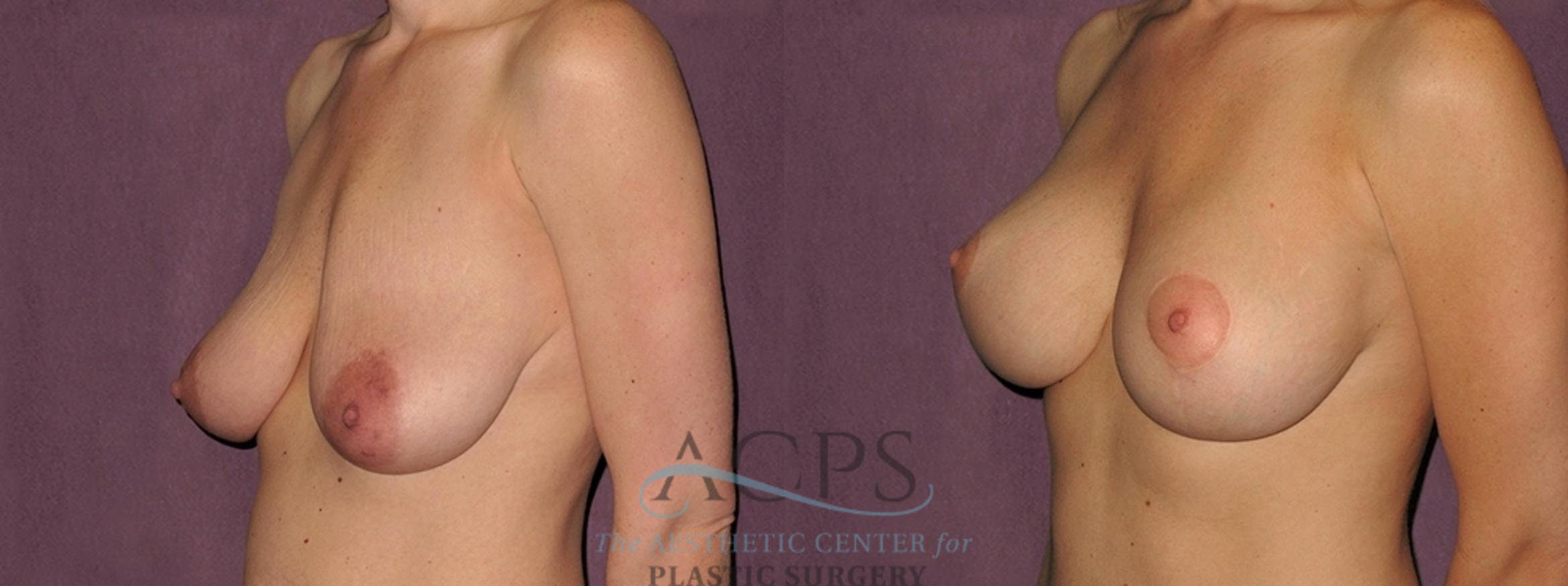 Before & After Breast Augmentation and Lift Case 1525 Left Oblique View in Houston, TX