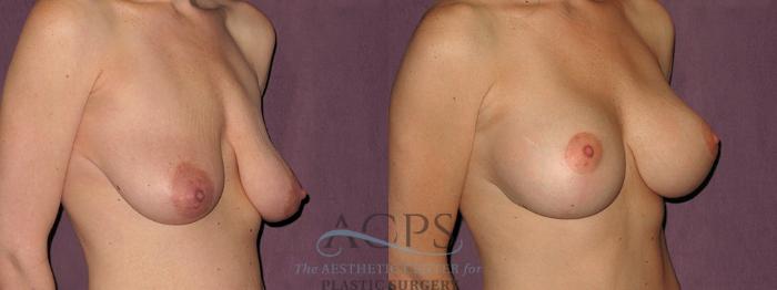 Before & After Breast Augmentation and Lift Case 1525 Right Oblique View in Houston, TX