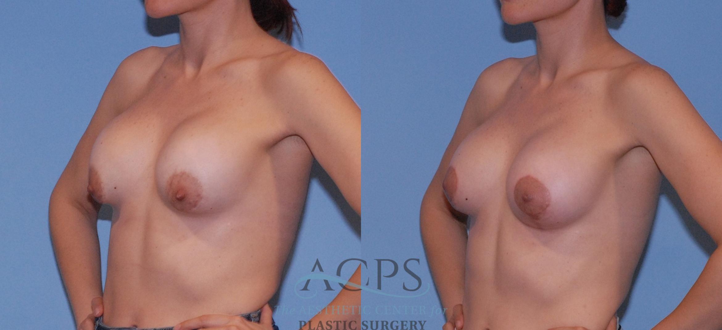 Before & After Breast Augmentation and Lift Case 1553 Left Oblique View in Houston, TX