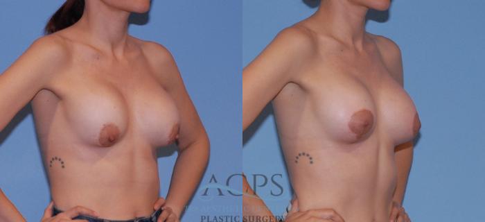 Before & After Breast Augmentation and Lift Case 1553 Right Oblique View in Houston, TX