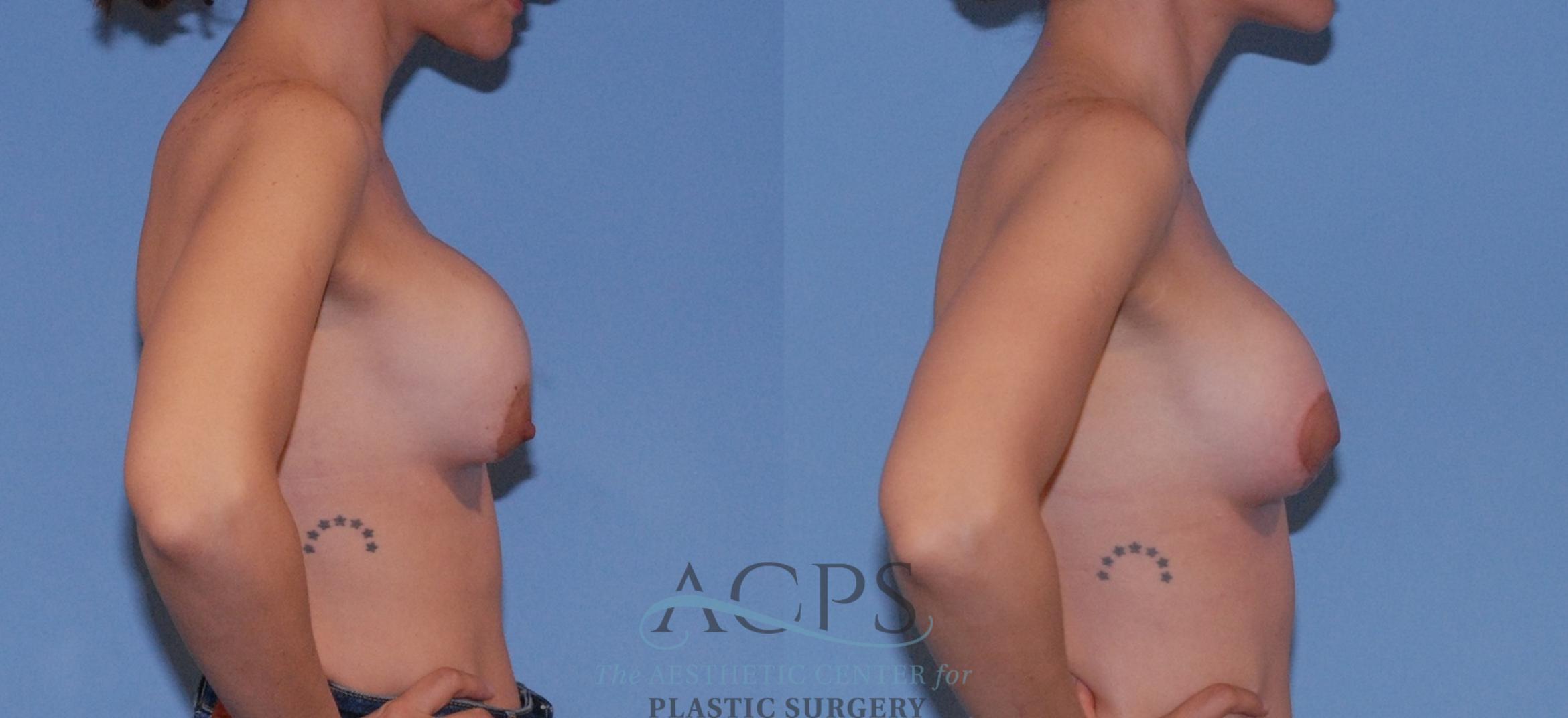 Before & After Breast Augmentation and Lift Case 1553 Right Side View in Houston, TX