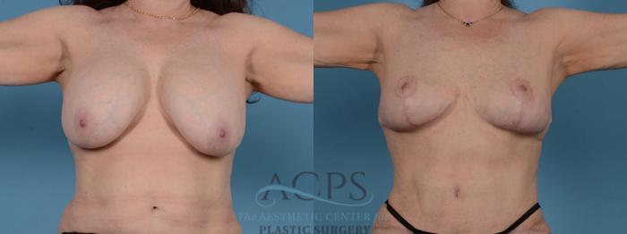 Before & After Breast Fat Grafting Case 1197 Front View: View in Houston, TX