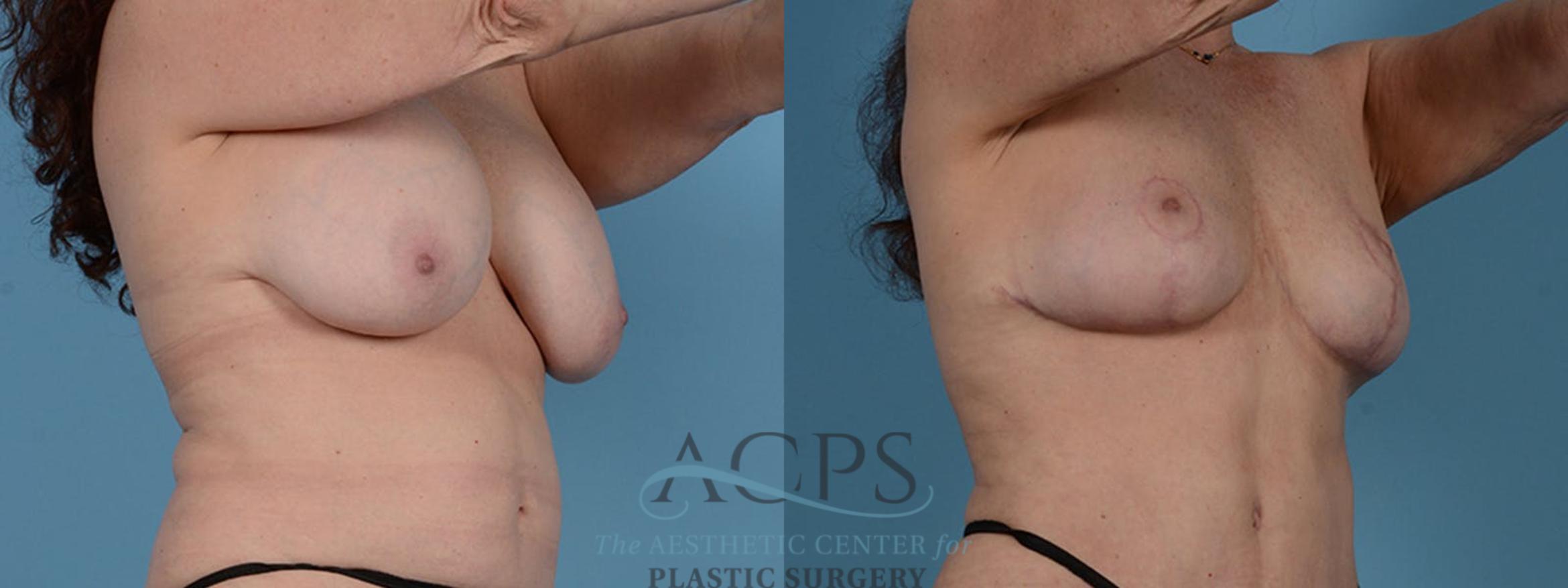 Before & After Breast Fat Grafting Case 1197 Oblique View: View in Houston, TX