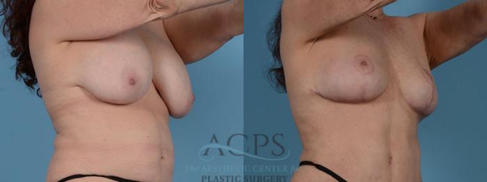 Before & After Breast Fat Grafting Case 1197 Oblique View: View in Houston, TX