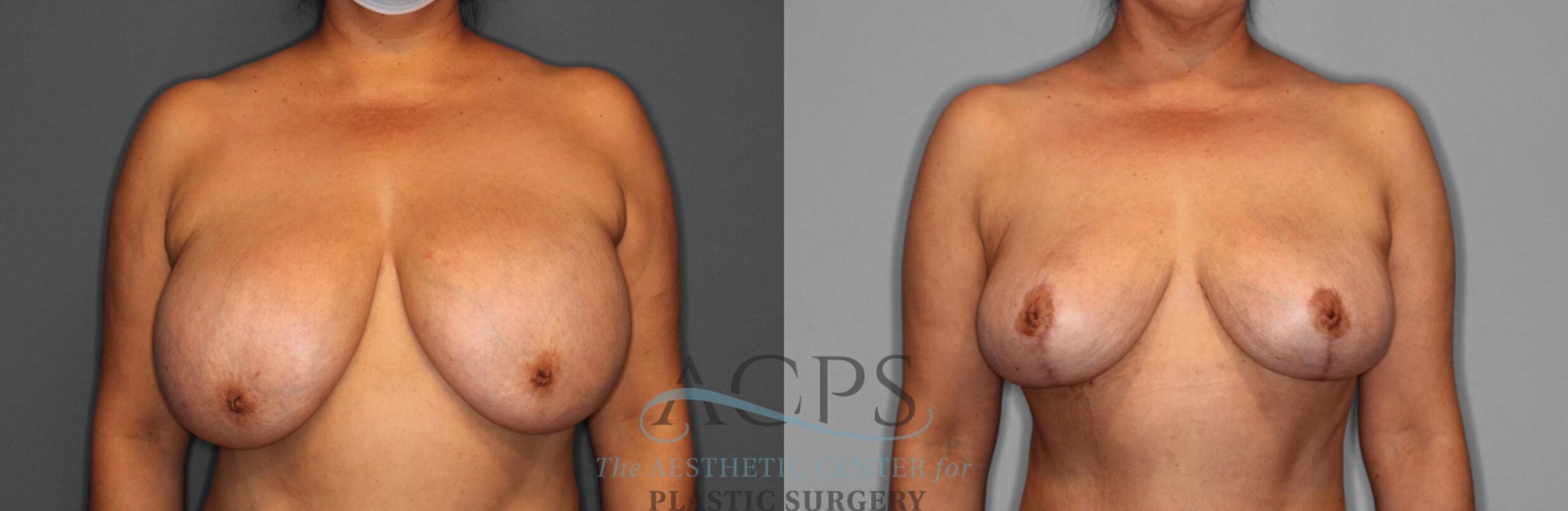 Before & After Breast Lift Case 1093 Front View: View in Houston, TX