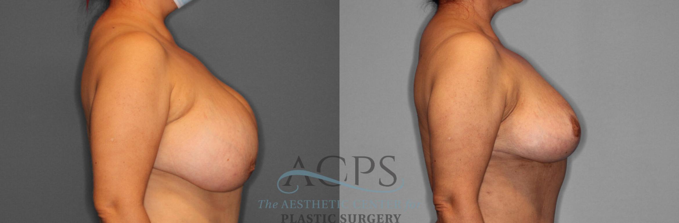 Before & After Breast Lift Case 1093 Side View: View in Houston, TX
