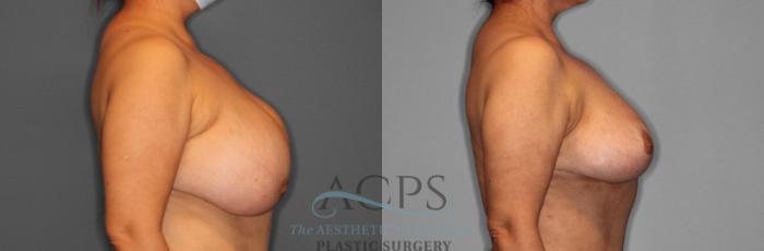 Before & After Breast Lift Case 1093 Side View: View in Houston, TX
