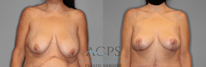 Before & After Breast Lift Case 1094 Front View: View in Houston, TX
