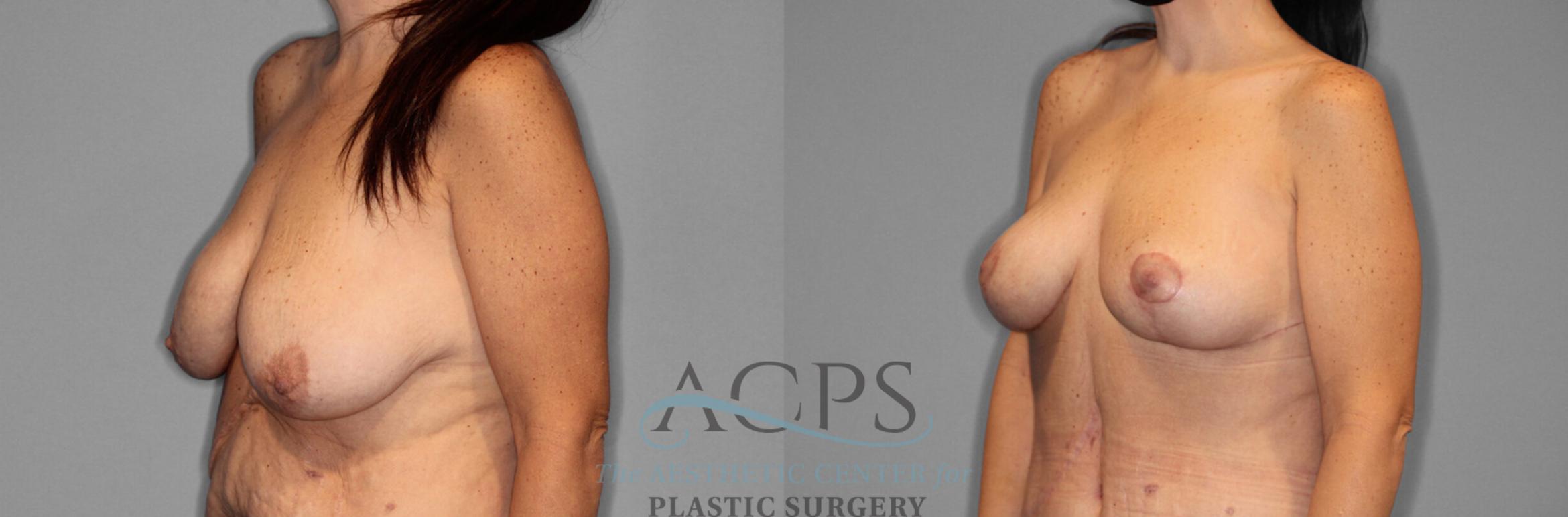 Before & After Breast Lift Case 1094 Oblique View: View in Houston, TX