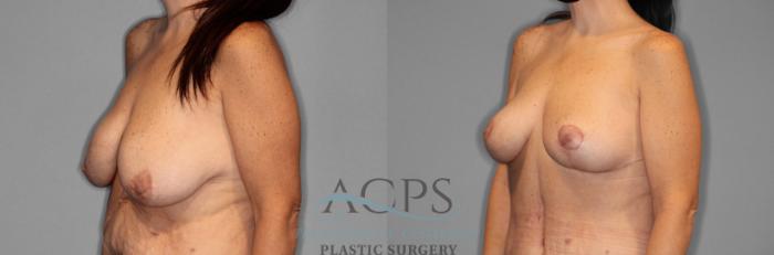 Before & After Breast Lift Case 1094 Oblique View: View in Houston, TX