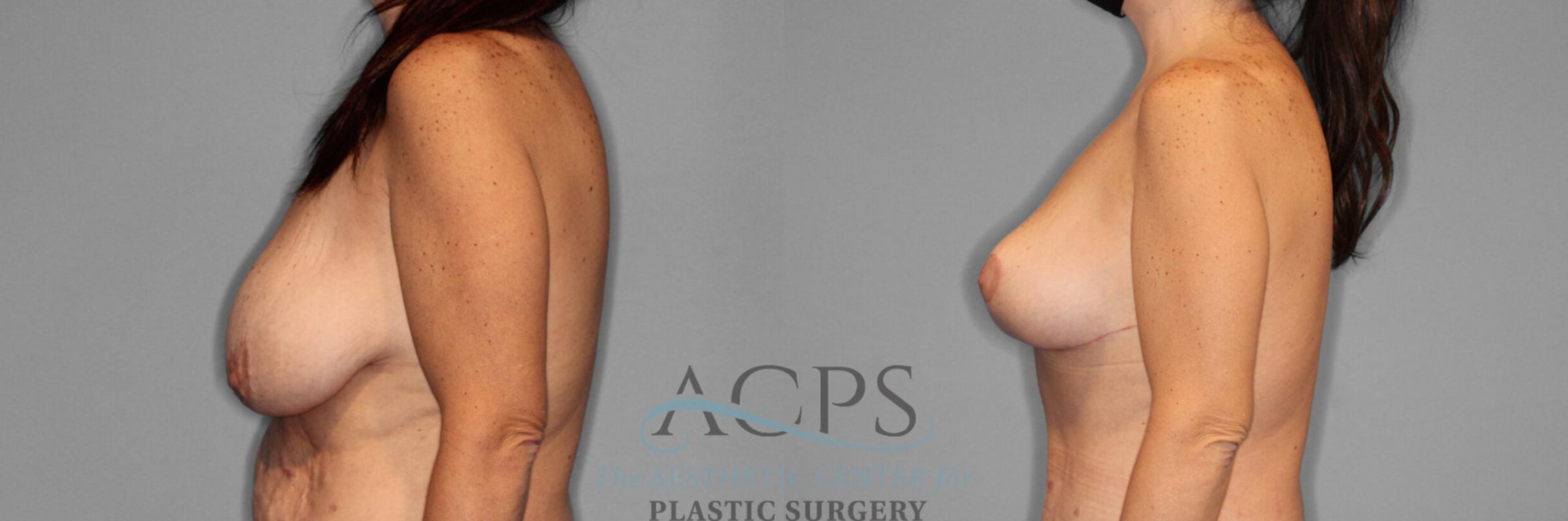Before & After Breast Lift Case 1094 Side View: View in Houston, TX
