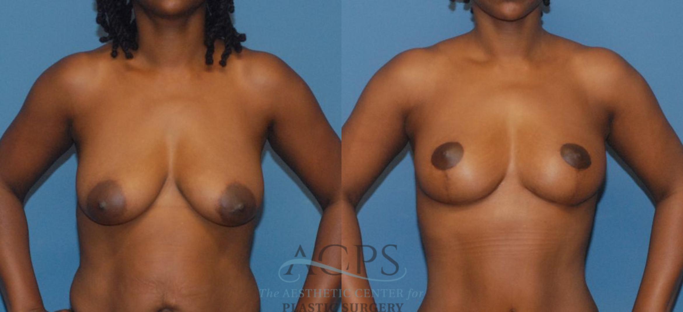 Before & After Breast Lift Case 1096 Front View: View in Houston, TX