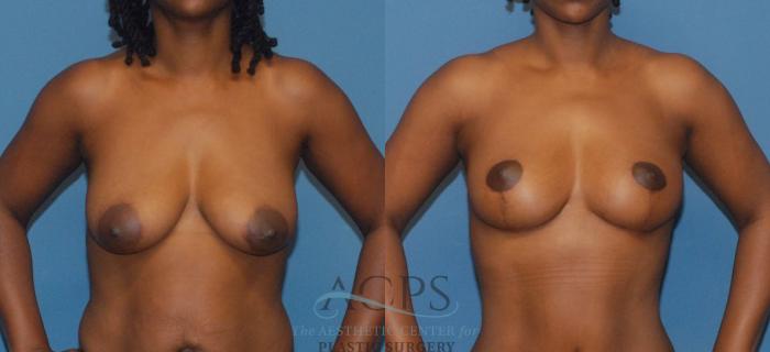 Before & After Breast Lift Case 1096 Front View: View in Houston, TX