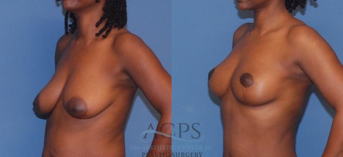 Before & After Breast Lift Case 1096 Left Oblique View: View in Houston, TX