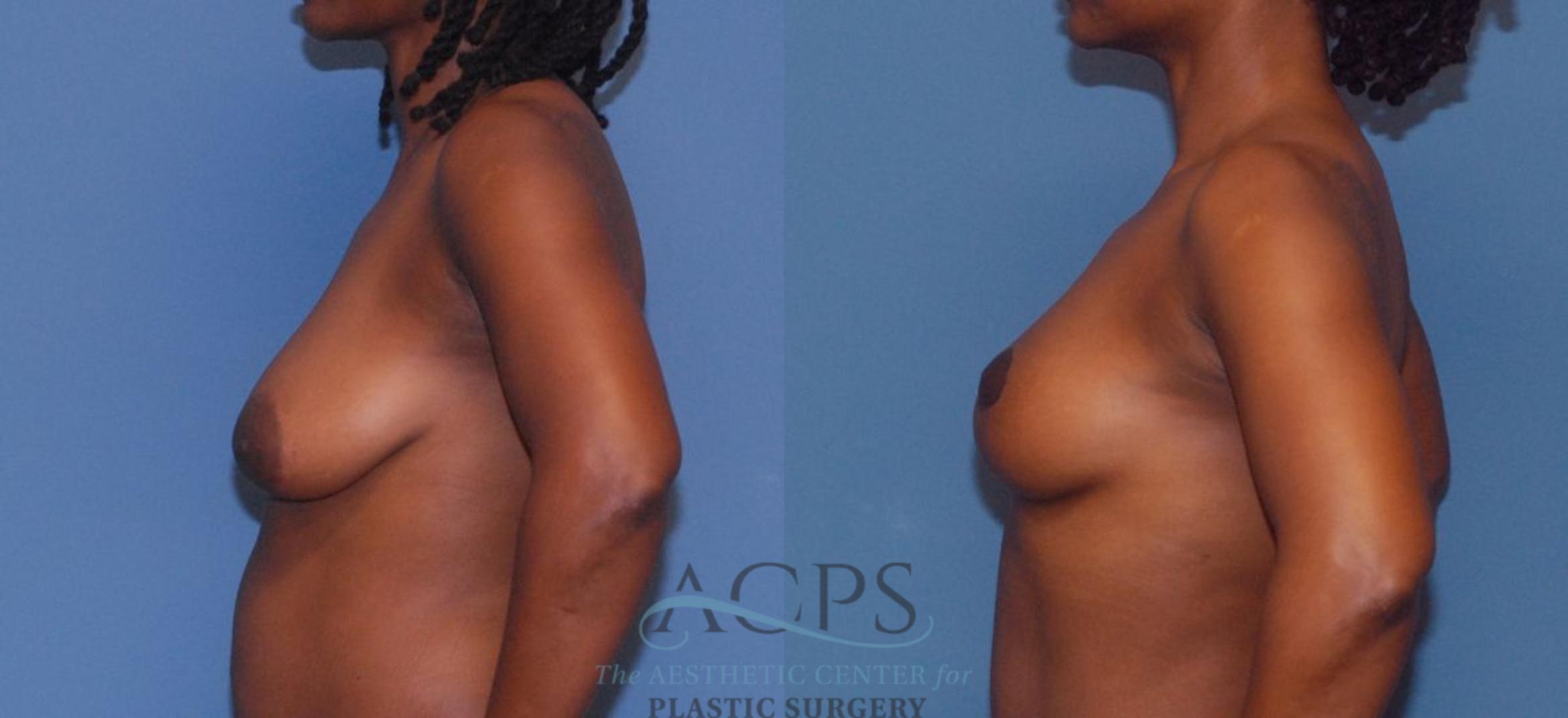 Before & After Breast Lift Case 1096 Left Side View: View in Houston, TX