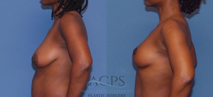 Before & After Breast Lift Case 1096 Left Side View: View in Houston, TX