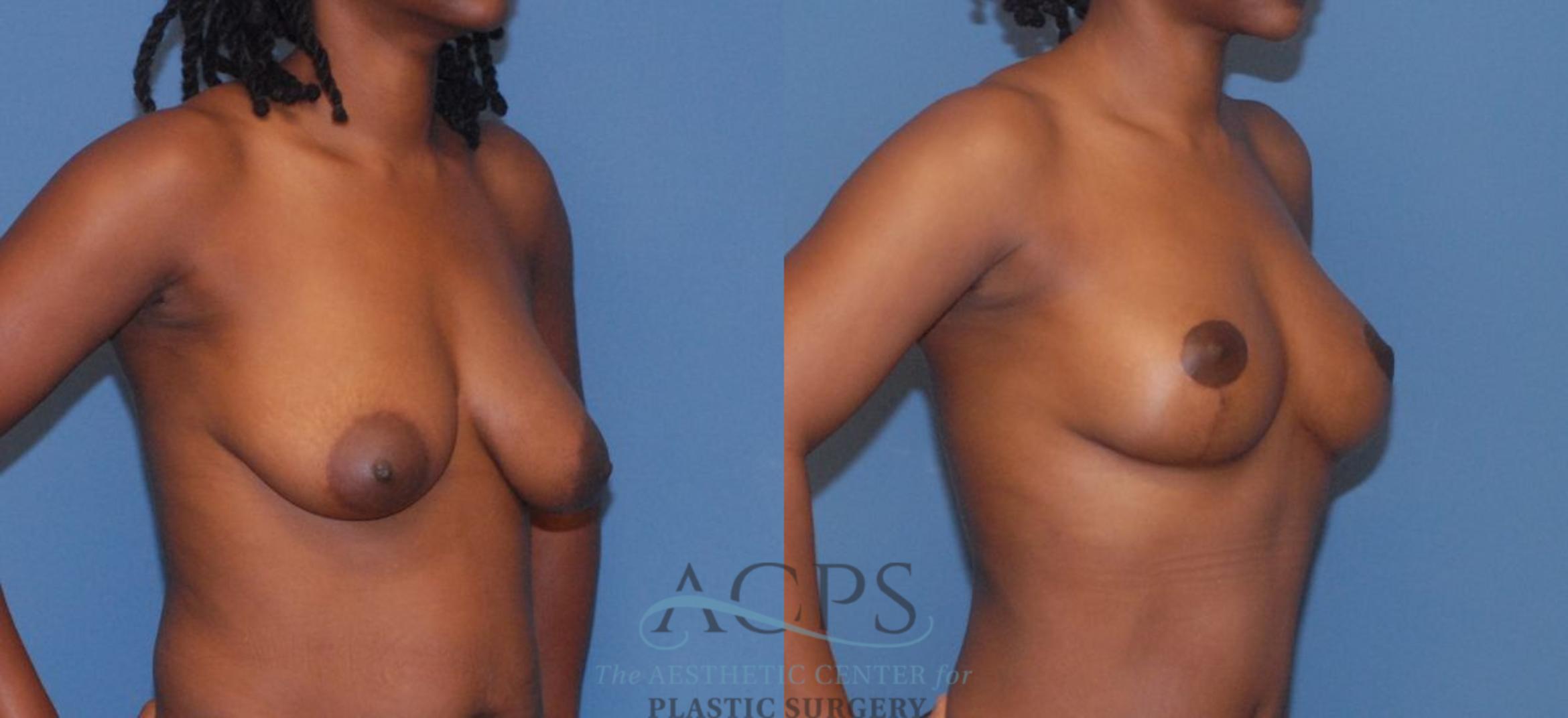 Before & After Breast Lift Case 1096 Oblique View: View in Houston, TX