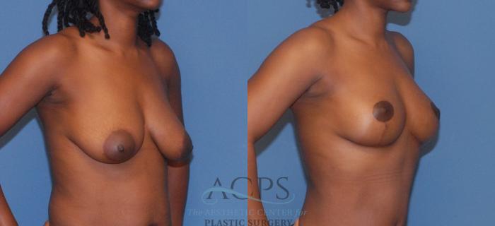 Before & After Breast Lift Case 1096 Oblique View: View in Houston, TX