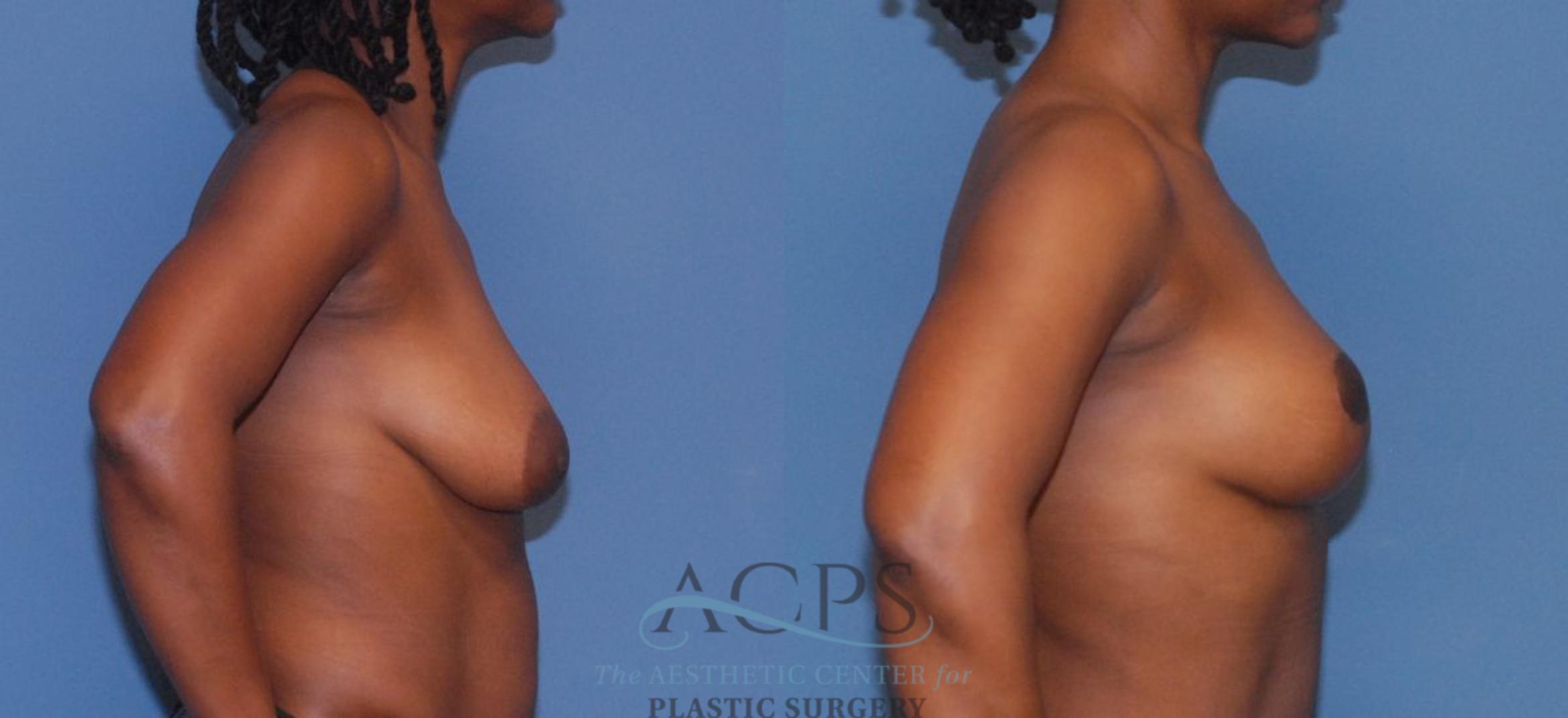 Before & After Breast Lift Case 1096 Right Side View: View in Houston, TX