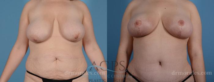 Before & After Breast Lift Case 1097 Front View: View in Houston, TX