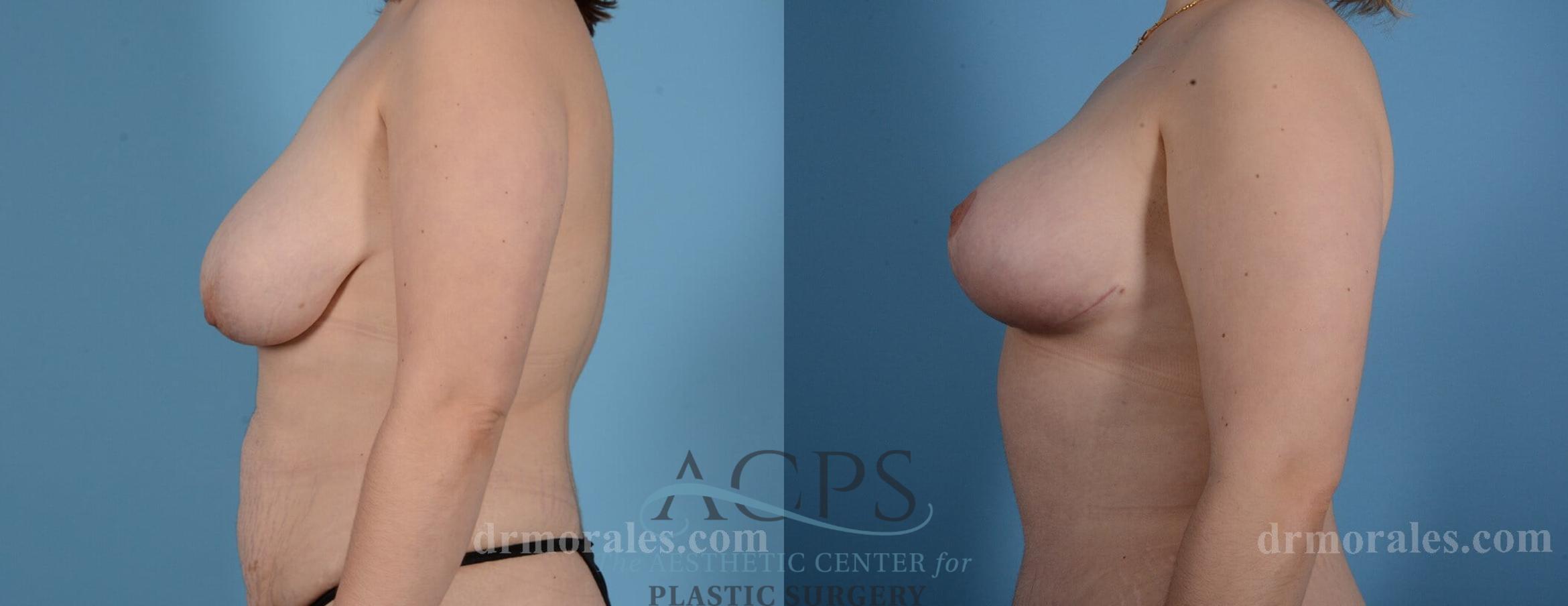 Before & After Breast Lift Case 1097 Side View: View in Houston, TX