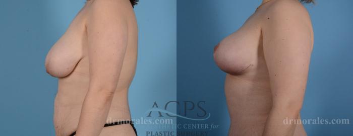 Before & After Breast Lift Case 1097 Side View: View in Houston, TX