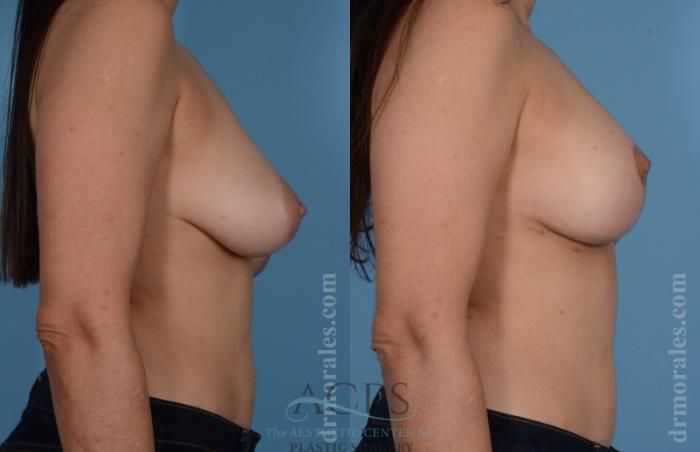 Before & After Breast Lift Case 1098 Side View: View in Houston, TX