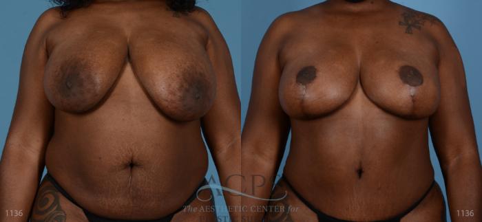 Before & After Breast Lift Case 1099 Front View: View in Houston, TX