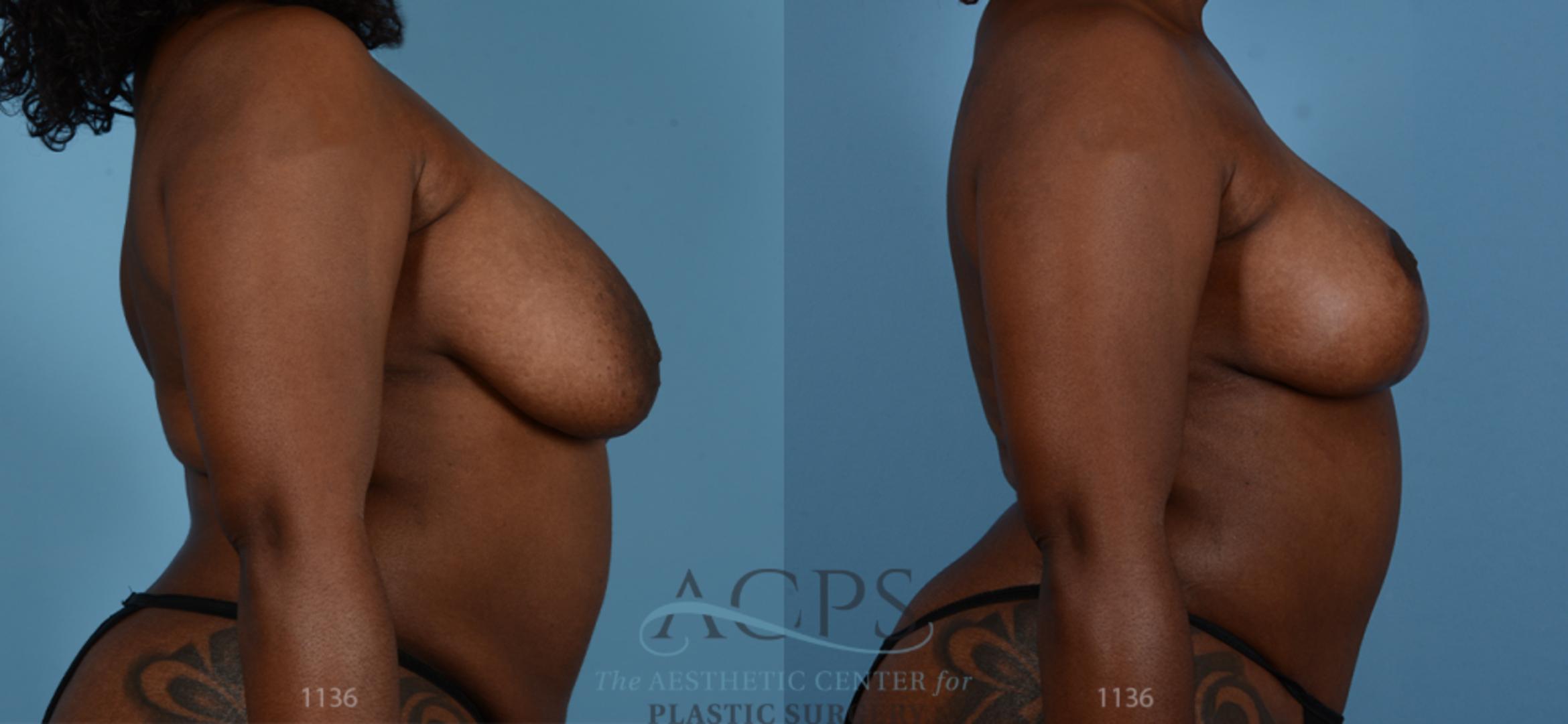 Before & After Breast Lift Case 1099 Side View: View in Houston, TX