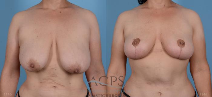 Before & After Breast Lift Case 1100 Front View: View in Houston, TX