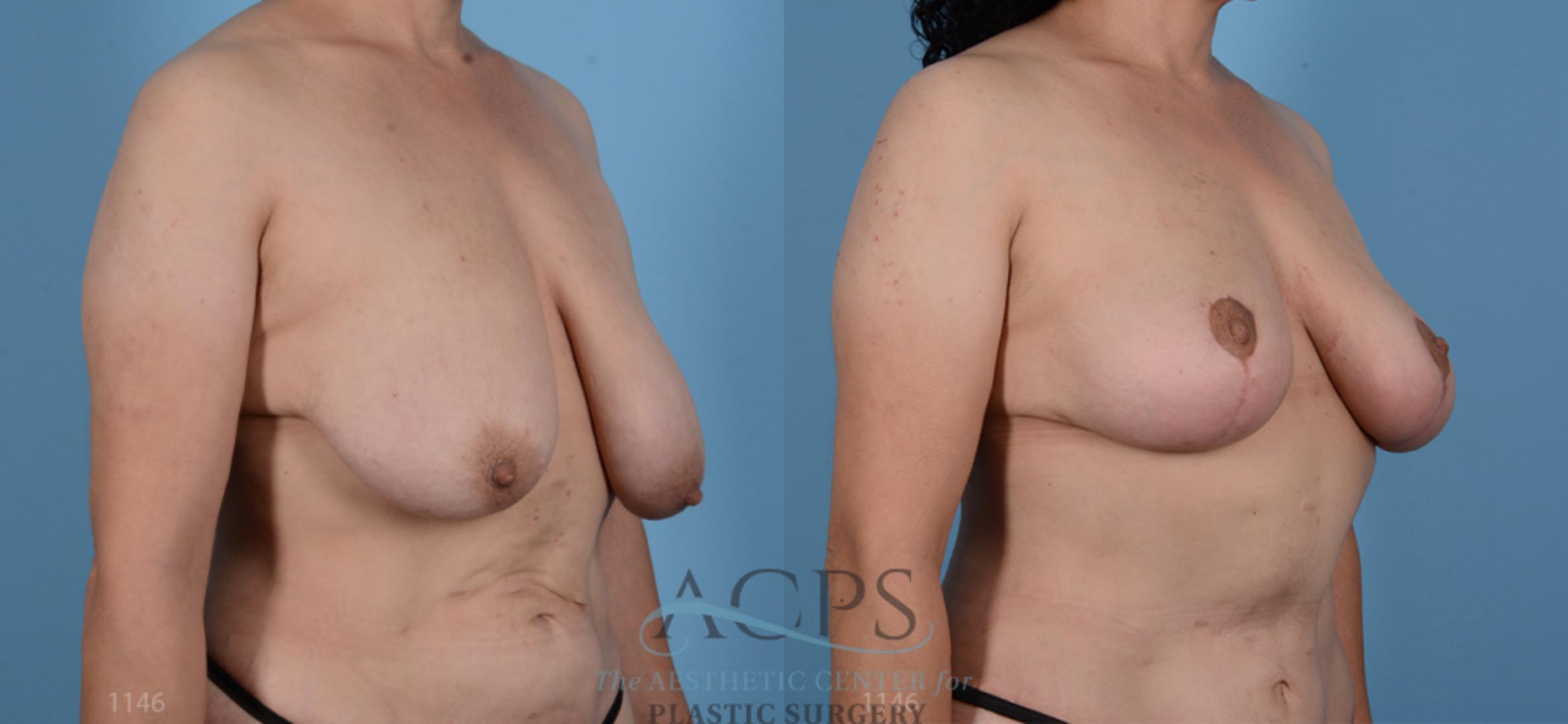 Before & After Breast Lift Case 1100 Oblique View: View in Houston, TX