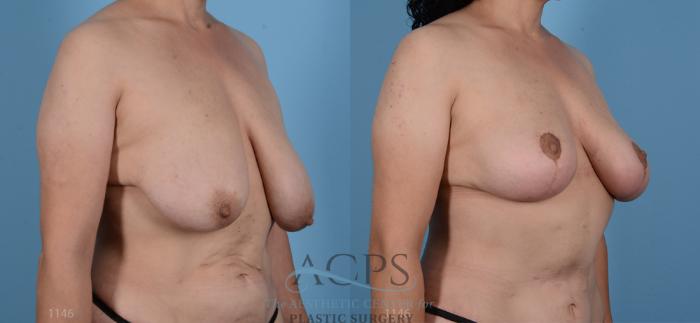 Before & After Breast Lift Case 1100 Oblique View: View in Houston, TX