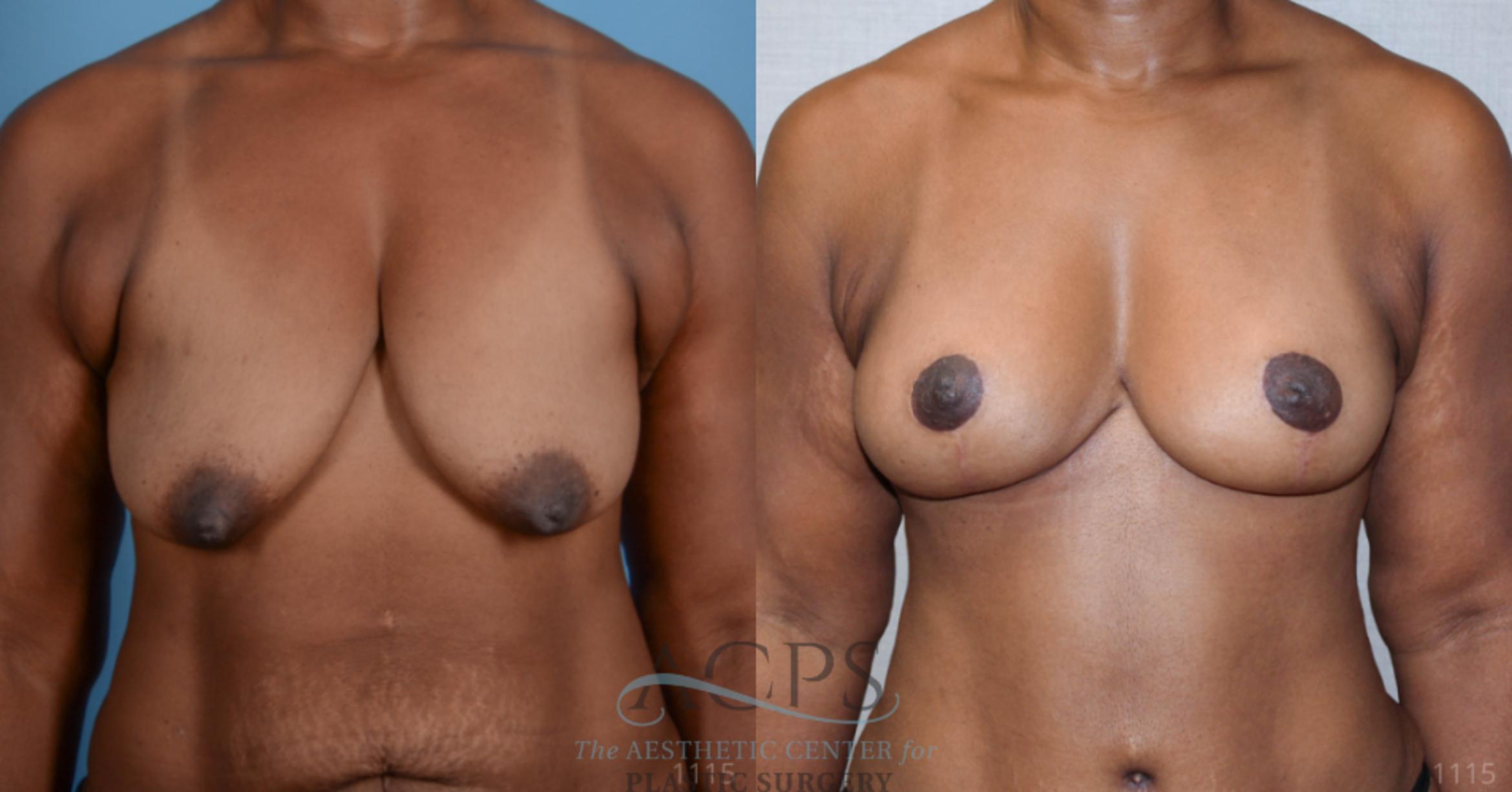 Before & After Breast Lift Case 1101 Front View: View in Houston, TX