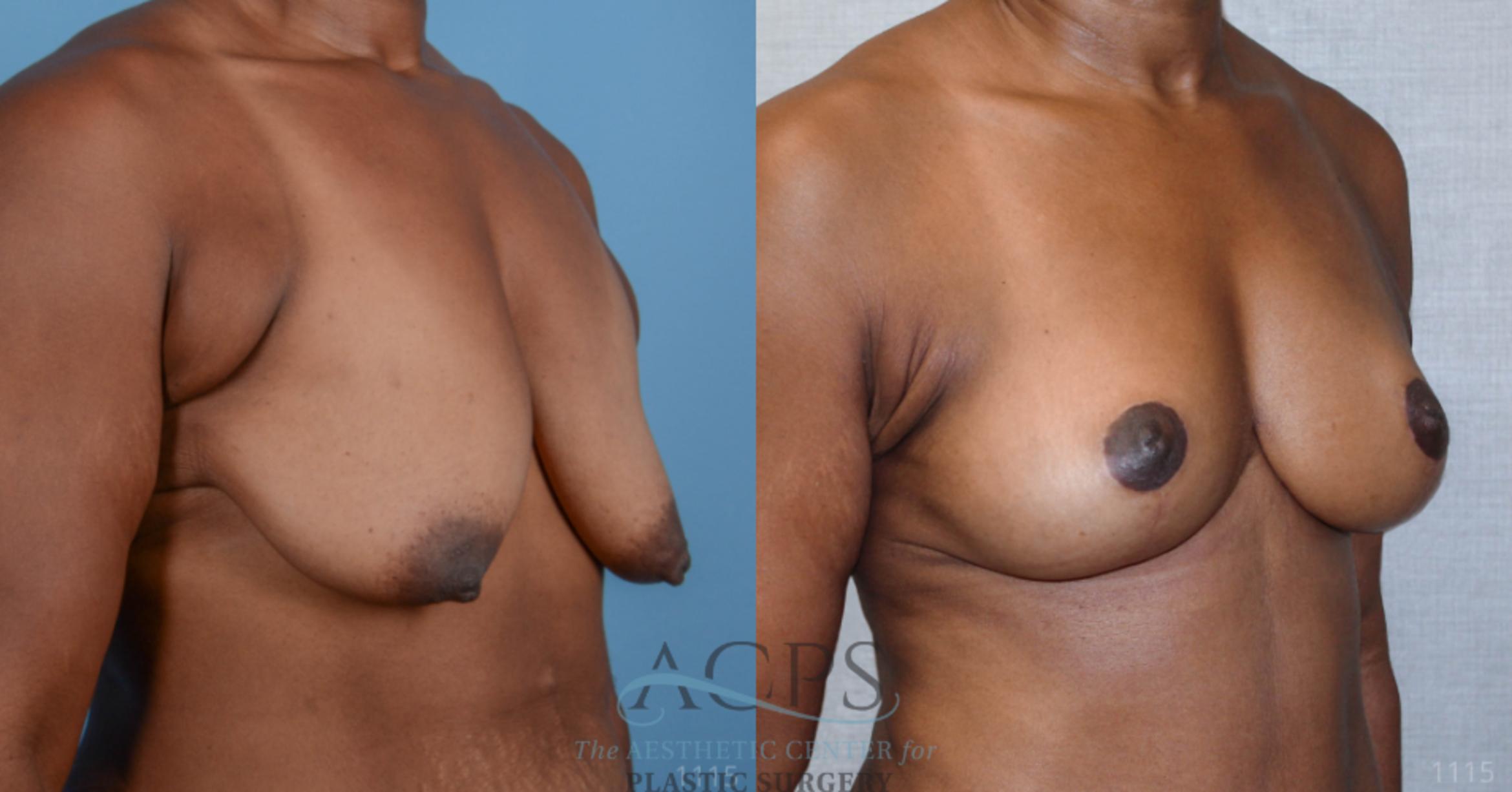 Before & After Breast Lift Case 1101 Oblique View: View in Houston, TX