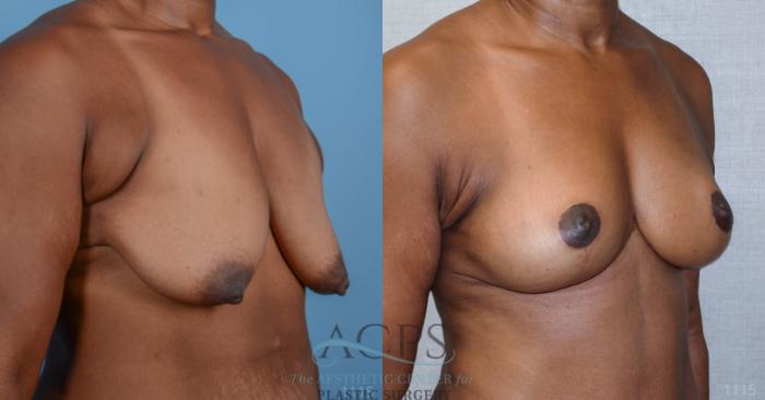 Before & After Breast Lift Case 1101 Oblique View: View in Houston, TX